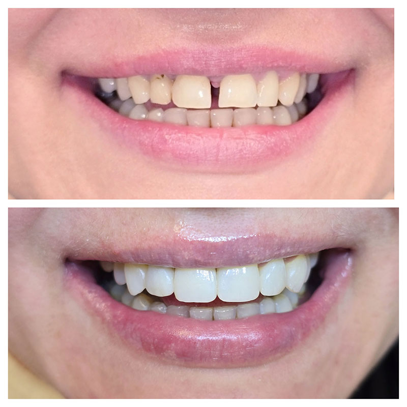 Estetinis dantų plombavimas